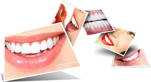 Veneers Hollywood Smile