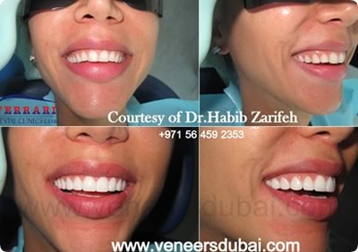 Veneers Dubai by Dr. Habib Zarifeh