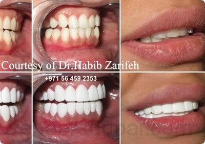 Veneers Dubai by Dr. Habib Zarifeh