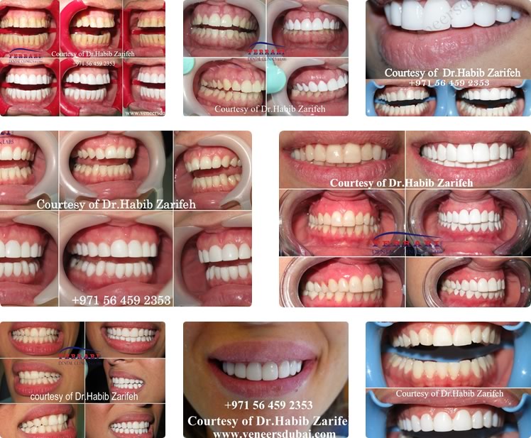 Veneers Dubai by Dr. Habib Zarifeh