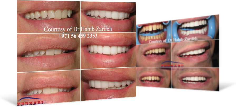 prepless veneers dubai 1