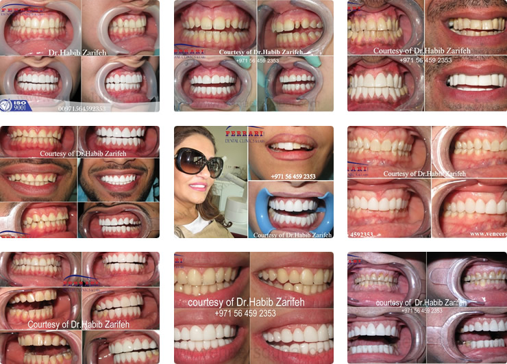 Veneers Dubai by Dr. Habib Zarifeh