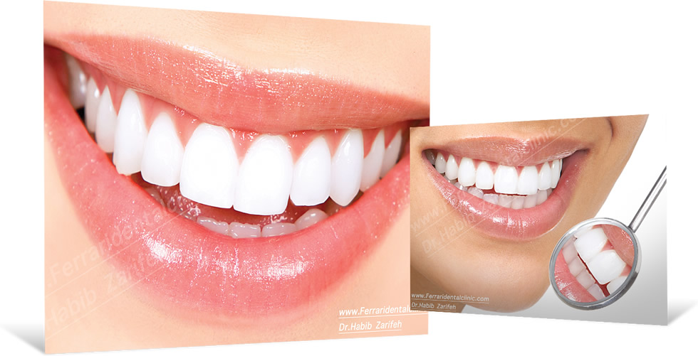 veneers dubai top